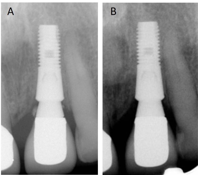 Fig. 7: Radiographic evaluation is required following cementation of crowns. A) An immediate post-operative photograph of a cement-retained crown reveals cement along the mesial and distal abutment walls. Radiographic evidence, is of course incomplete as the buccal and lingual surfaces must be carefully investigated clinically. B) Subsequent radiograph taken after successful attempts were made to remove residual cement using hand instruments. This vigilant approach to managing cement-retained crowns is advocated
