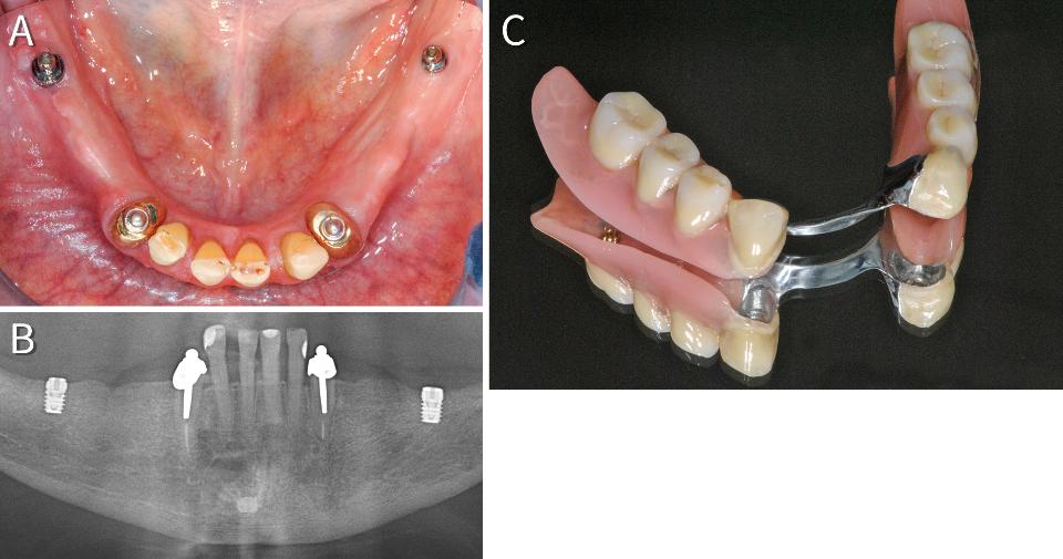 Fig. 14: Clinical (A) and radiological (B) view of a 68-year-old patient’s lower jaw. Two short (6-mm) implants support the distal aspect of a RPDP (C) by means of dome-shaped attachments