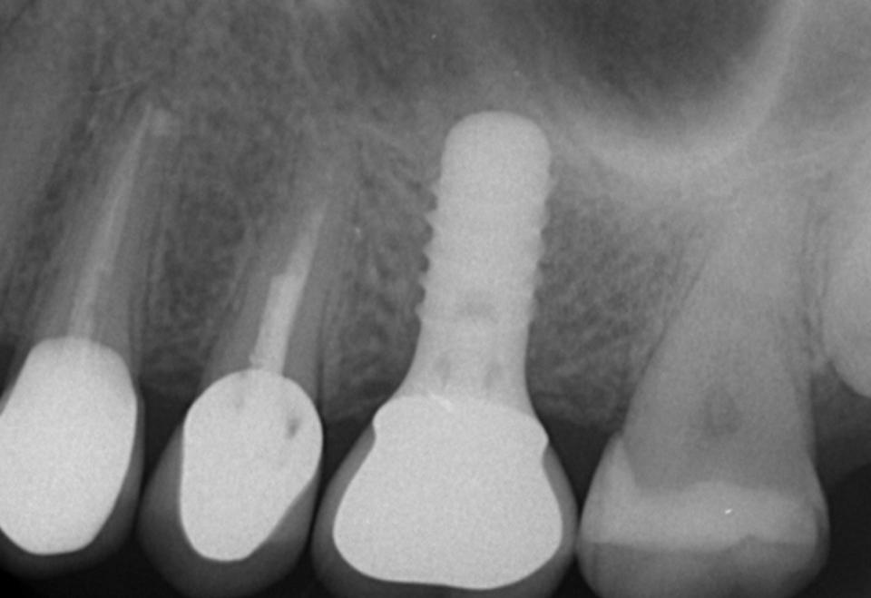 Fig. 8k: The periapical radiograph at the 10-year follow-up examination shows excellent peri-implant bone crest levels and a good periapical bone volume in the area of the former defect