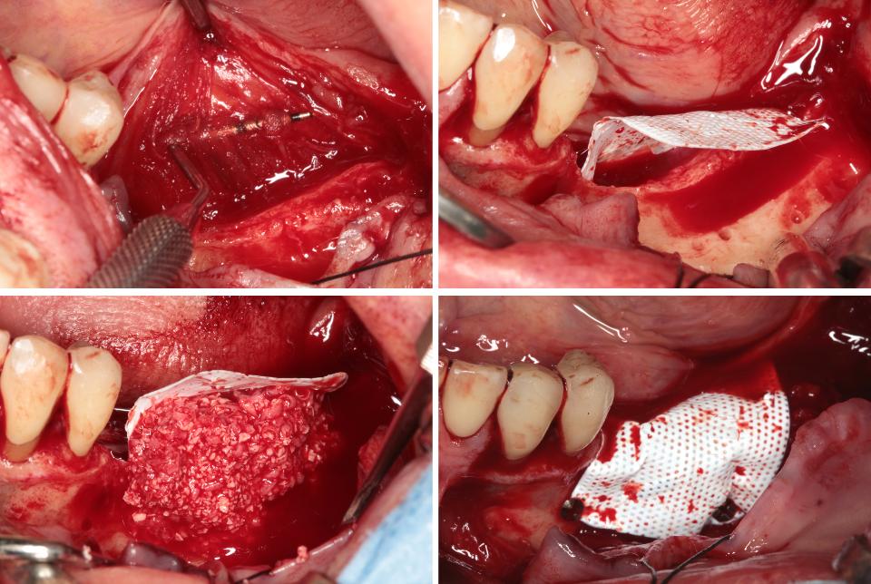 Fig. 3b: Augmentation step: The region was filled with autogenous bone chips and Bio-Oss® (Geistlich AG, Wolhusen, Switzerland). A non-resorbable titanium-reinforced barrier membrane (Cytoplast®, Flexident AG, Stansstad, Switzerland) was placed over the graft and fixed with tacks. The flap was sutured