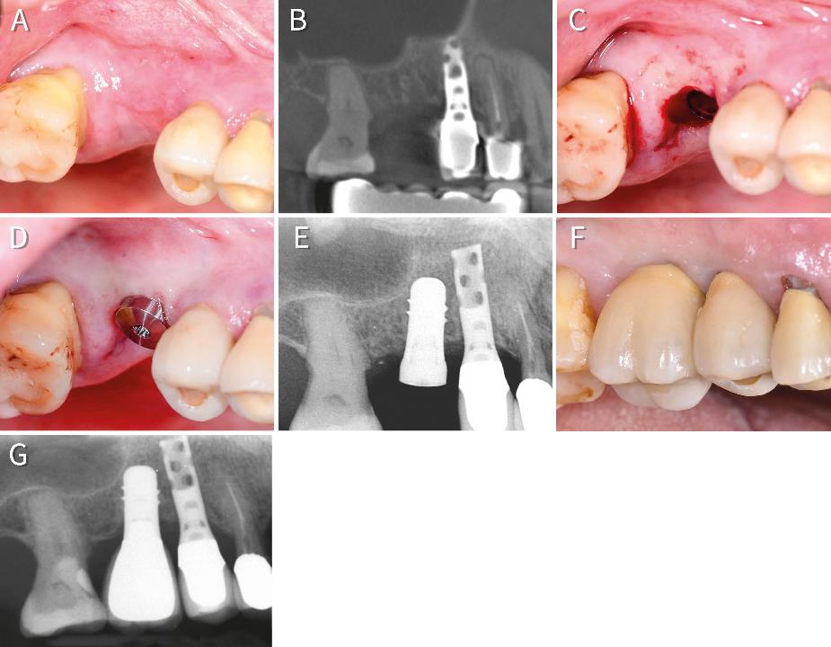 Fig. 8: 85-year-old patient with a single-tooth gap in close proximity of the maxillary sinus floor (A, B). Sufficient crest width allows for flapless placement of a 6-mm short implant (C, D, E). The peri-implant tissue around the single tooth restoration with a moderate crown-to-implant ratio show healthy conditions after 4 years in function (F, G)
