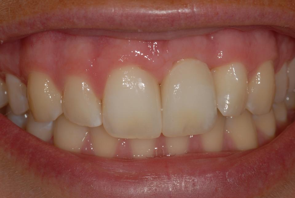 Fig. 3h: The direct comparison before (3g) and after (3h) completion of the combined adhesive and implant-based therapy underlines a marked improvement of a previously – from an esthetic point of view – severely compromised condition, despite the presence of a marked “gummy smile”. On the other hand, the clearly limited restorative possibilities when it comes to the correction of marked vertical soft tissue deficiencies have to be underlined