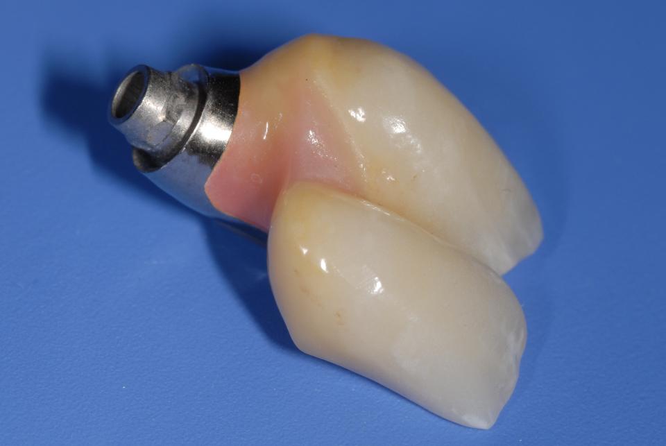 Fig. 4c: For esthetic reasons a small amount of pink ceramic has been added in the papillary region of the 2-unit implant FDP. Note the clearly convex profile of the entire cervical aspect of the restoration. This is mandatory to create favorable conditions for adequate daily homecare with the use of Superfloss®
