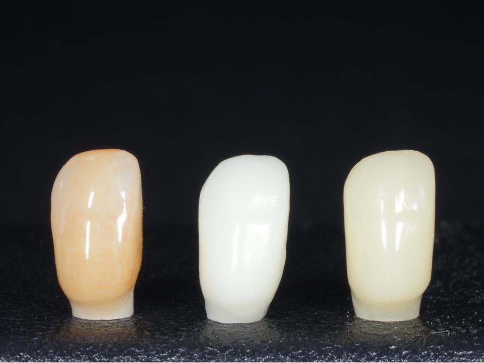 Fig. 2c: A partir da esquerda: coroa final sobre implante fabricada subtrativamente (zircônia após coloração); coroa provisória sobre implante impressa em 3D fabricada aditivamente; coroa provisória sobre implante fabricada subtrativamente (PMMA) (imagem cortesia de Dr. Yukihiro Takeda e TPD Kenta Matsuda)