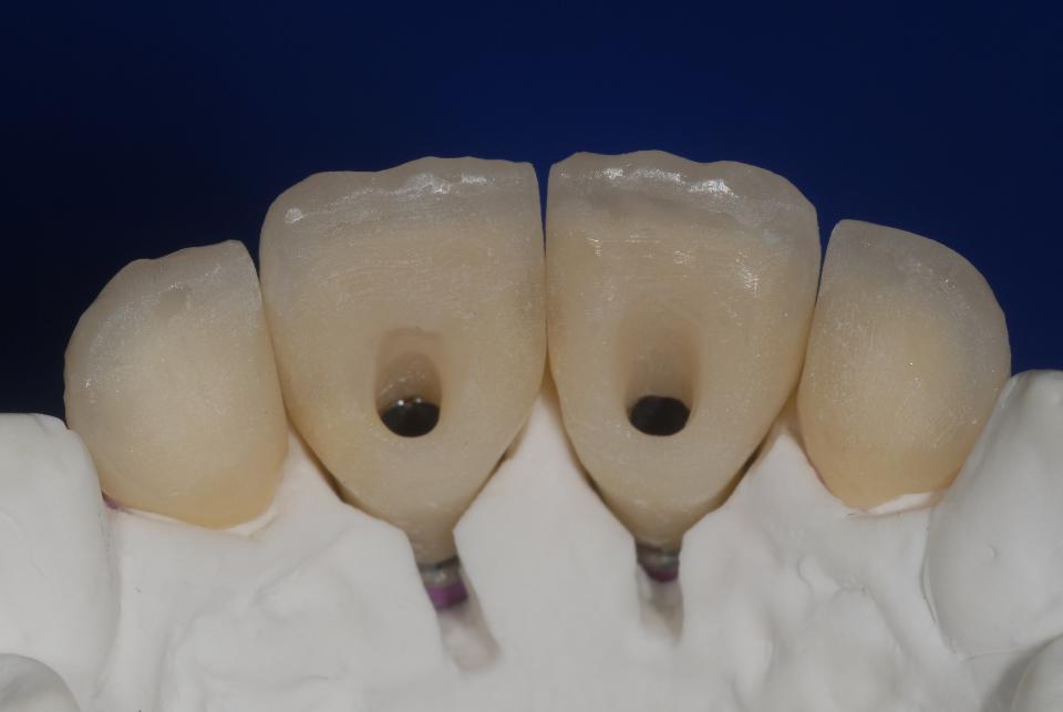 Fig. 6j: The corresponding palatal aspect shows that the adequate three-dimensional implant positioning allowed application of the recommended direct screw-retention design, without interfering with the optimal incisal-edge location or causing a too voluminous cingular area