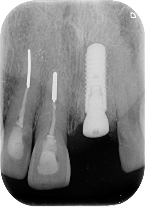 Fig. 20: Periapical radiograph 3 months after implant insertion