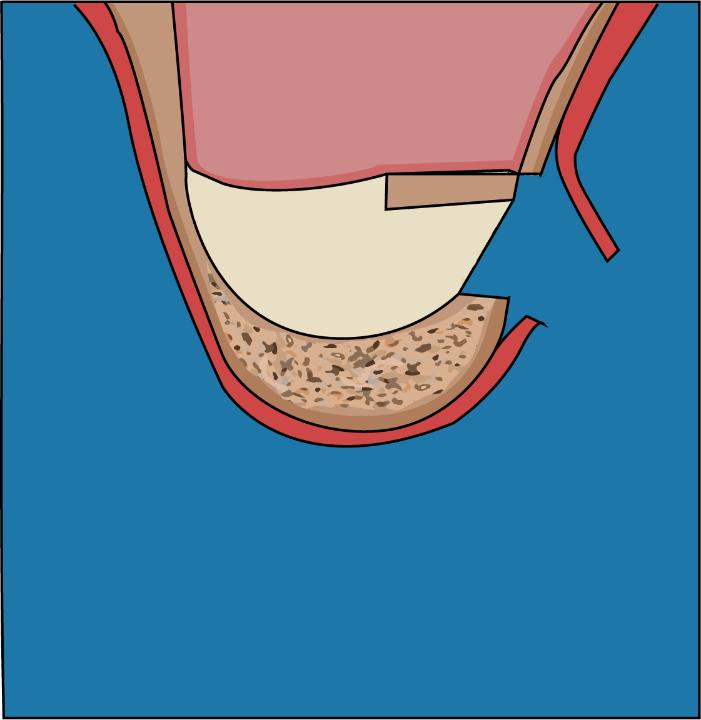 Fig. 4a: Creating a window in the lateral wall of the sinus cavity