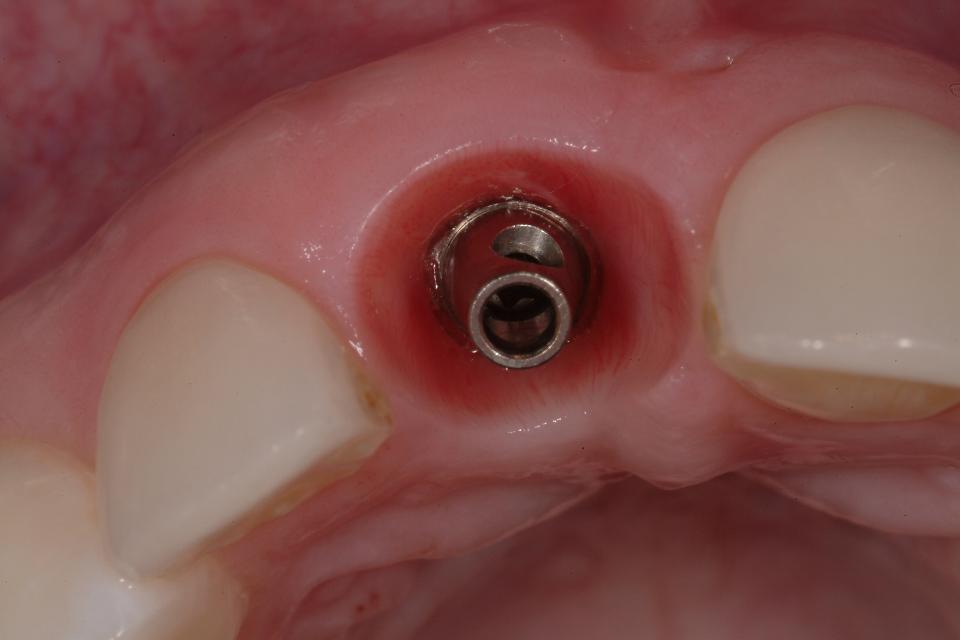 Fig. 19b: Occlusal view with crown off showing thickness of labial tissue