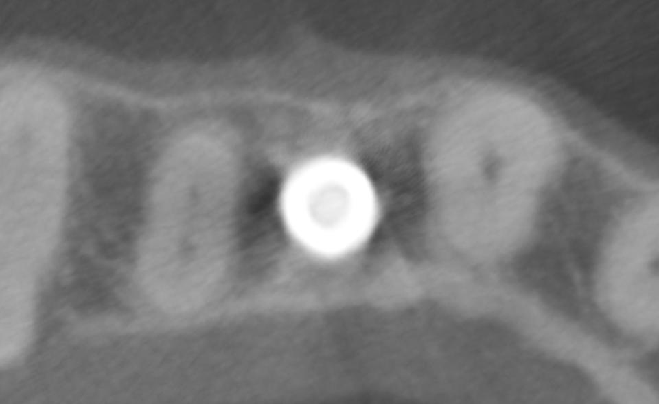 Fig. 6e: The horizontal cut of the CBCT shows the thick facial bone wall after 20 years of function