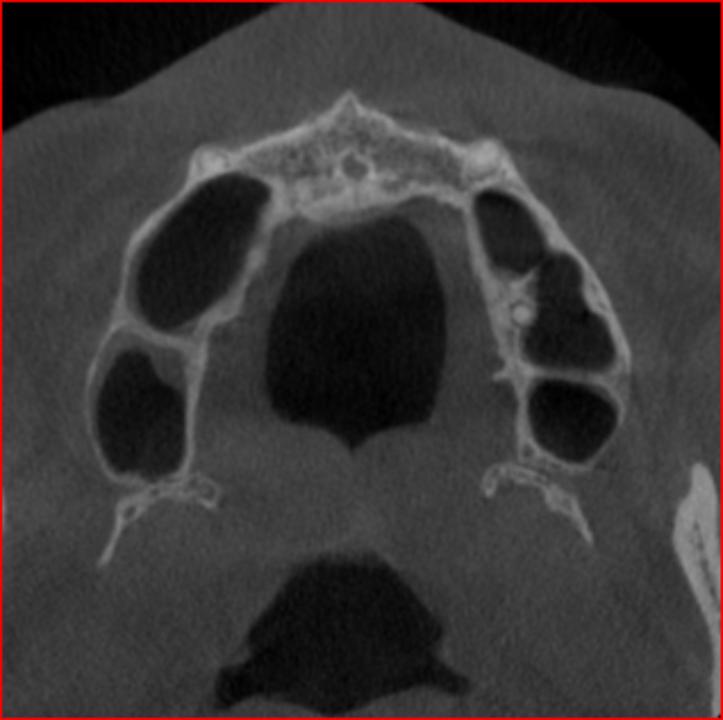 Fig. 6b: Axial CBCT image showing that the septa led to division of the sinus cavity