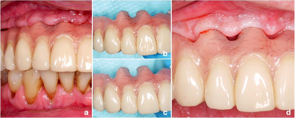 图3: 上颌全牙弓修复伴右侧种植体周围黏膜炎。修复体没有清洁通道，患者不能使用牙间隙刷(a)。修整修复体(b - c)使患者能够更轻松地清洁桥体龈端和种植体周围(d)