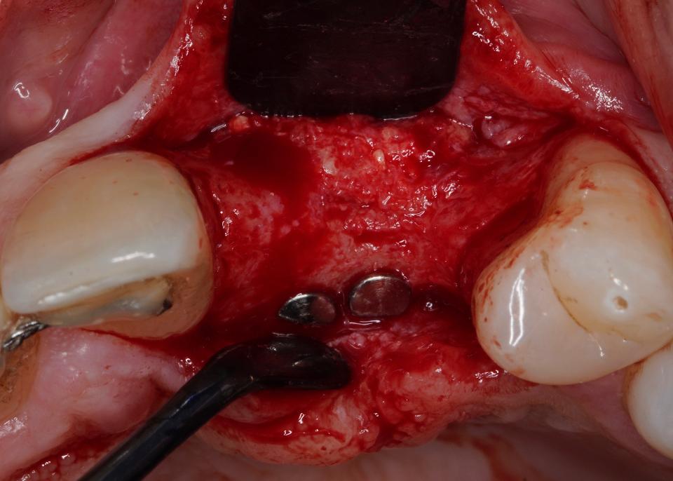 Fig. 5: Al rientro è presente osso vitale, completamente integrato nella cresta alveolare residua. I chiodini visibili sulla superficie palatale sono stati rimossi prima dell'inserimento dell'impianto