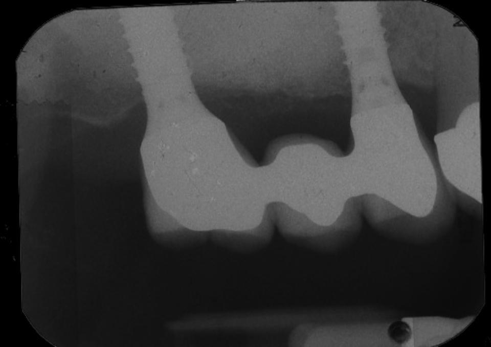 Fig. 3: One-piece implants supporting a FDP in the maxilla
