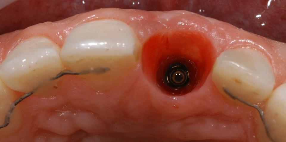 Fig. 10: Established healthy biological width/emergence profile around implant 21
