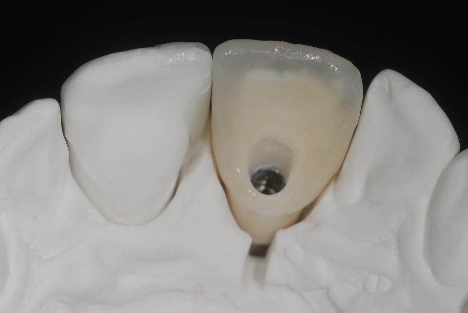 Fig. 3d: The palatal close-up view of the corresponding working model displays the final zirconia-based, directly screw-retained implant crown