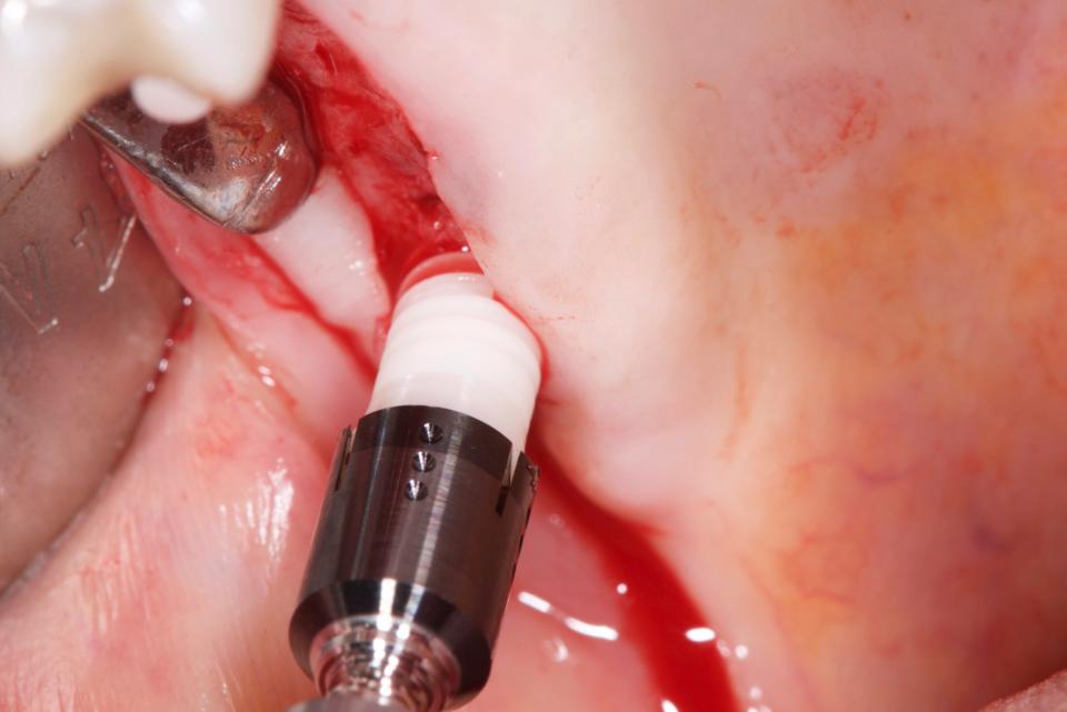 Fig 3a: Application d'un implant monobloc en zircone. La mise en place d'un implant sous contrôle prothétique est nécessaire pour une restauration scellée (Crédit photo : France Lambert).