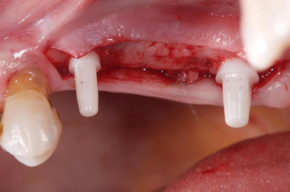 Fig. 3b: Los implantes unitarios de óxido de zirconio requieren retención de cemento. La colocación paralela de los implantes es fundamental, especialmente en las prótesis dentales fijadas con implantes de 3 unidades (Fotografía: France Lambert)