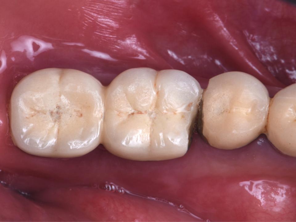 Fig. 5c: Technical complication: porcelain chipping of implant-supported splinted crowns