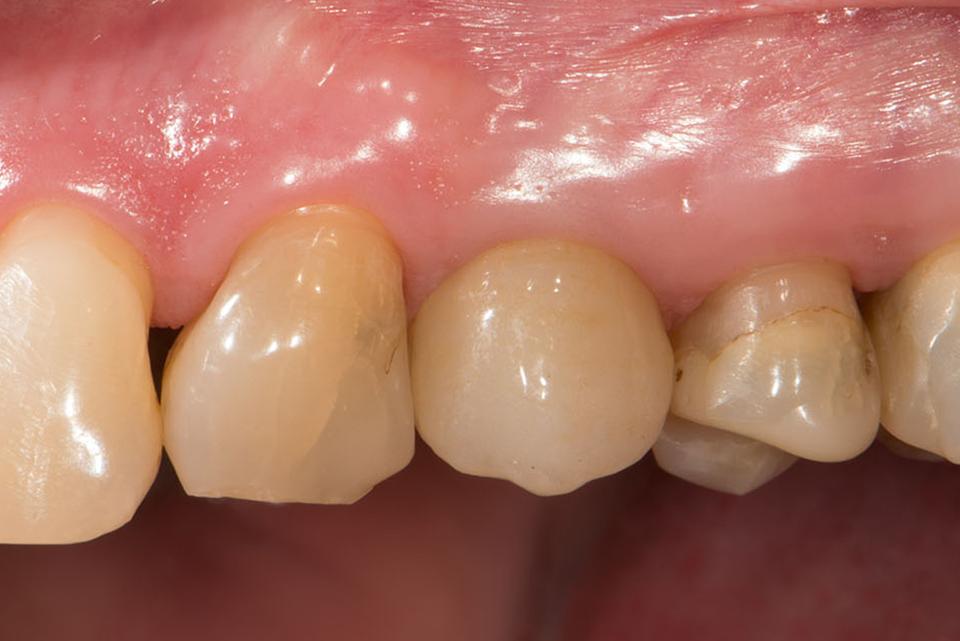 Fig. 4e: Delivery of implant-supported single crown 4 months after implant placement (Photo credit: Stefan Roehling)