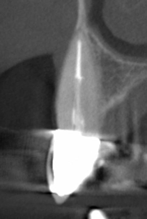 Fig. 3b: The orofacial CBCT shows no evidence of a facial bone wall
