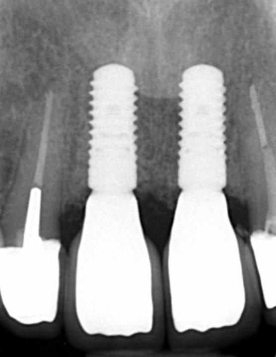 Fig. 6s: The corresponding peri-apical radiograph reveals optimal peri-implant bony conditions as well as minimal uniform support for the veneering ceramic provided by an optimally designed zirconia framework