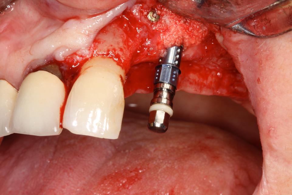 Fig. 10c: Placement of implant 22 