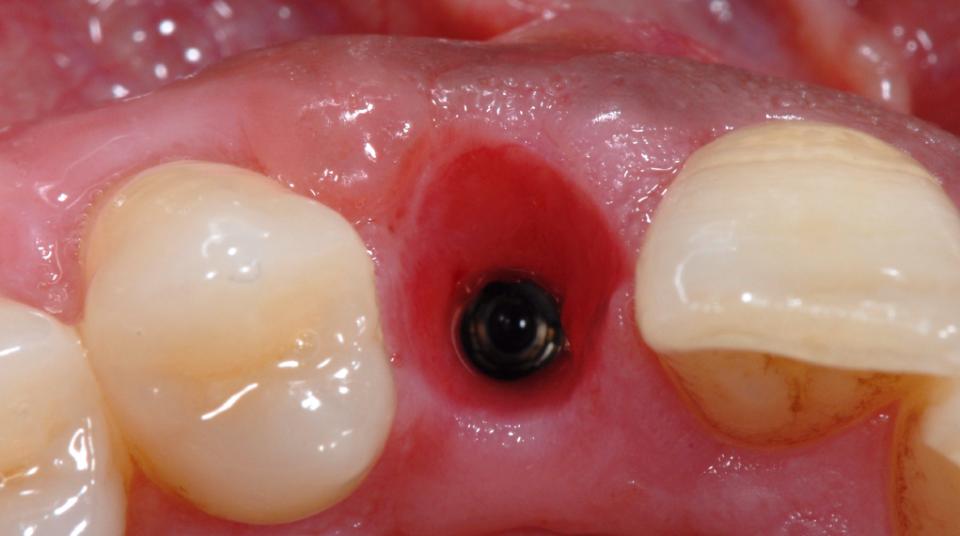 Fig. 5: Clinical situation with an implant in region 12 with ideal soft tissue conditions