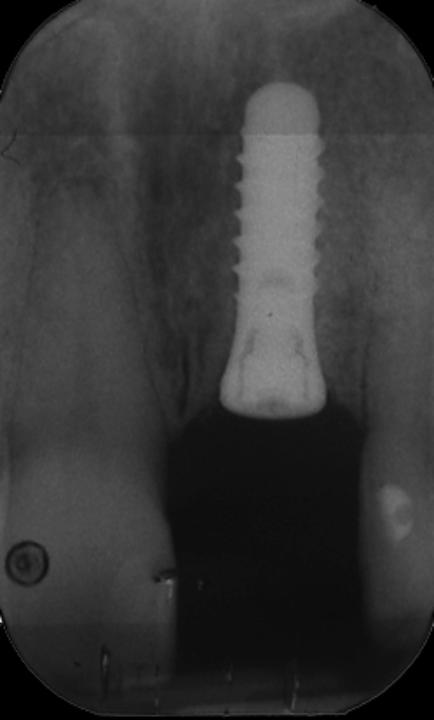 Fig. 7a: One-piece implant 21 with a subcrestal placement of the smooth implant neck