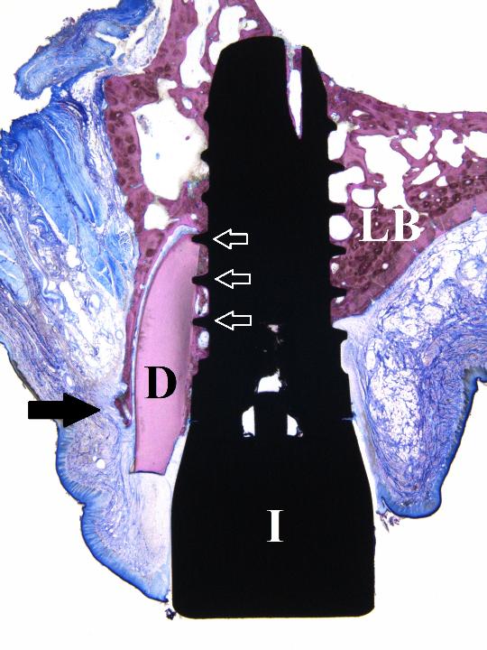 Fig. 15: Histological section from an animal study. D=shield, I=implant