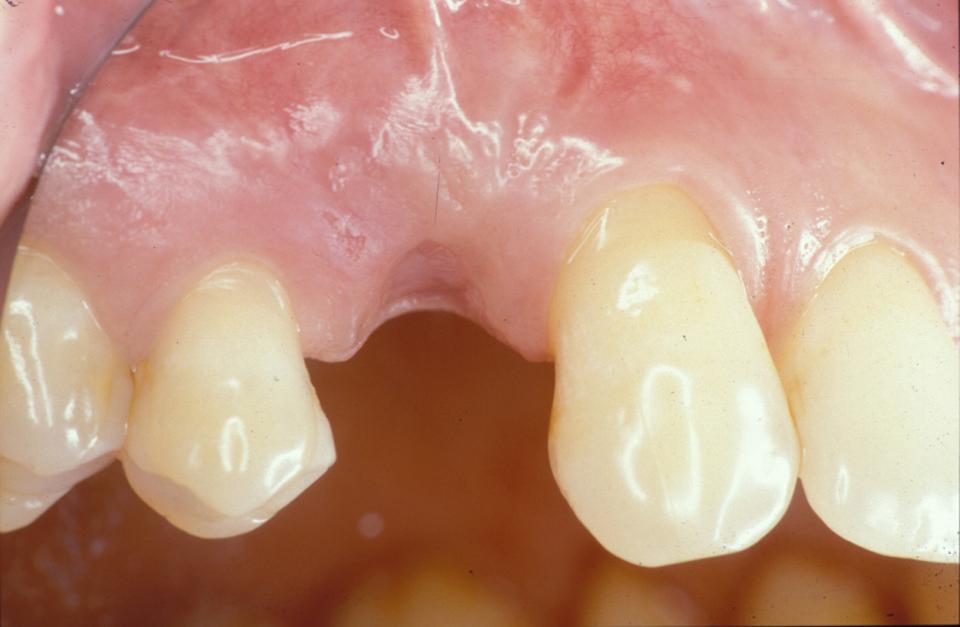 Fig. 6a: 20-year follow-up of the very first patient treated with early implant placement and simultaneous contour augmentation in January 1998:
Clinical status of the patient, 6 weeks following extraction of the first premolar by the referring dentist. Note the gingival recession at the canine