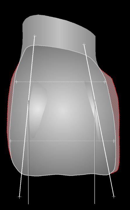 Fig. 2b: Schematic representation of the parameters that can be modified on a maxillary incisor in the case of vertical soft tissue deficiencies to create the optical illusion of balanced relative tooth dimensions (length-to-width ratio): position of the mesial and distal transition line angles, relative weight of the three facial compartments in the corono-apical direction, and palatally located prolonged interproximal contact lines