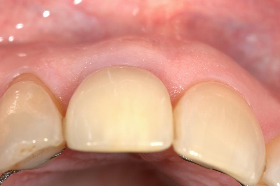 Fig. 10: Occlusal view 5 years after immediate implant placement with socket shield