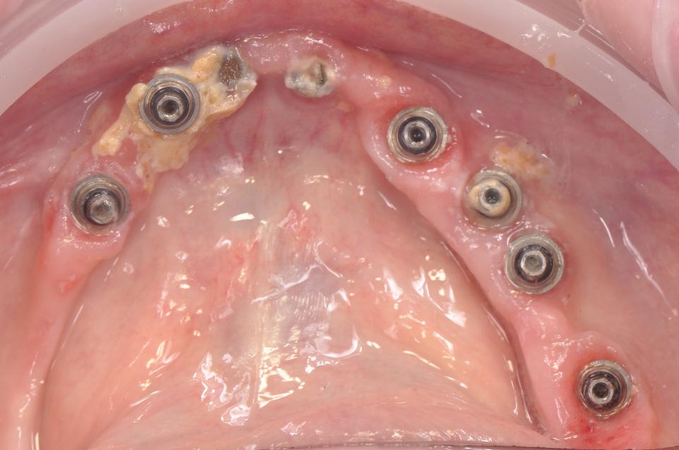 Fig. 1b: The alveolar mucosa, peri-implant mucosa and implant abutments are completely covered with adherent biofilm and calculus. Oral health cannot be maintained without altering the fixed prosthesis or considering a removable prosthetic alternative