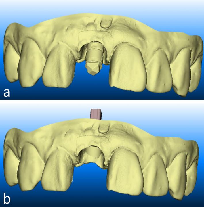 Figs 7: Digital impression of a scanbody (a) and its conversion to a virtual analog in a 3D model (b)