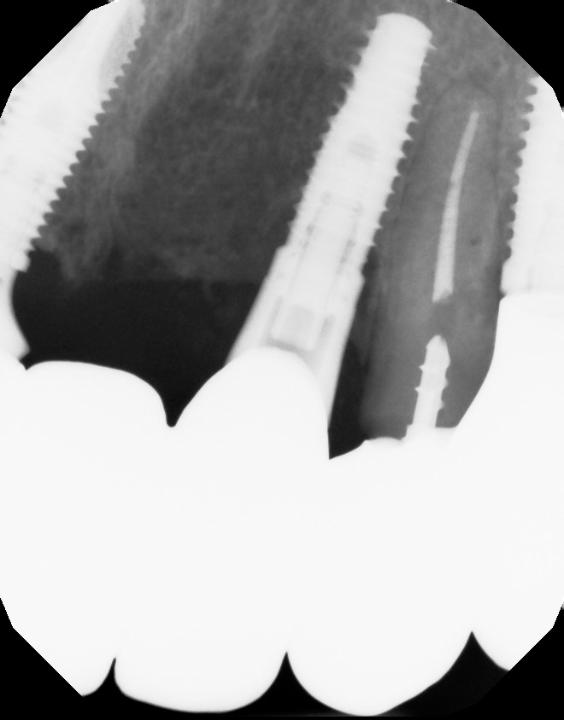 Fig. 4: Tapered implant is less likely to damage adjacent roots apically, when placed in close proximity. 6-year post-treatment