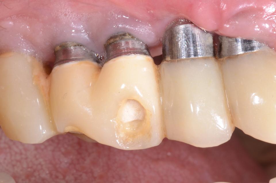 Fig. 11b: The facial close-up view reveals five adjacent implants supporting a screw-retained provisional FDP. Note that the screw-access channel of the center implant is located mid-facially