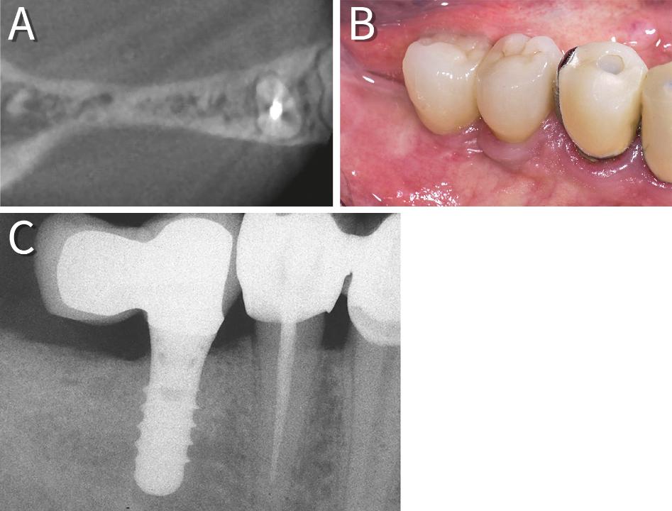 Fig. 13: This cantilever restoration in the atrophic mandible allowed to avoid complex bone grafting procedures. Preoperative horizontal CBCT view of the horizontal atrophy (A), clinical (B) and periapical/cross-sectional findings (C) after 10 years in function