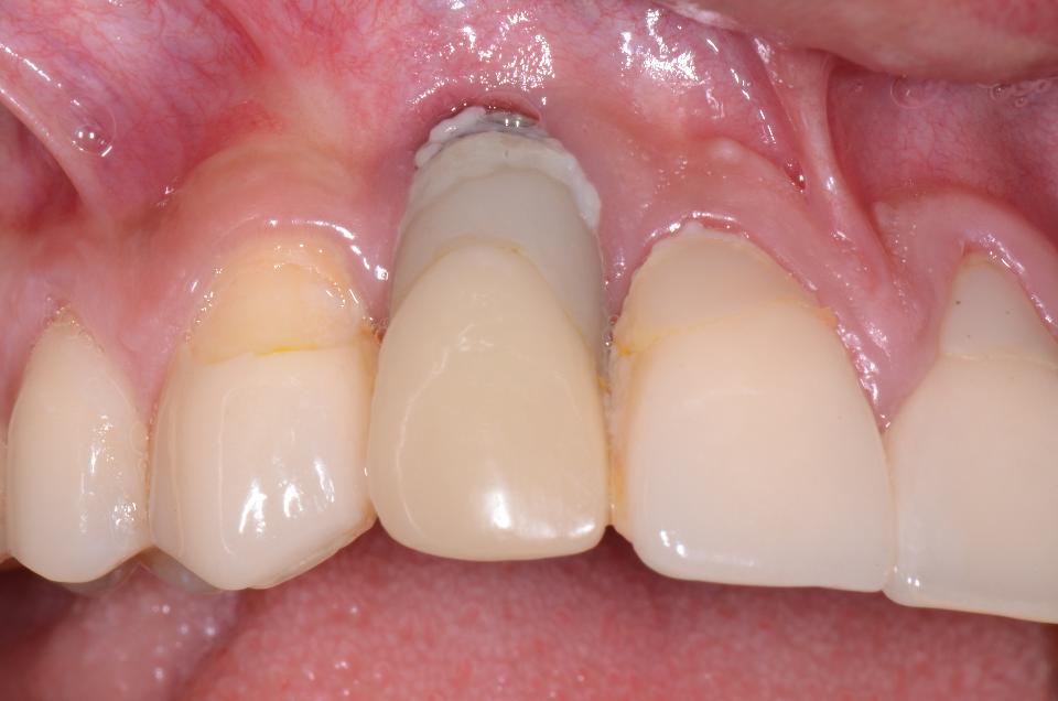 Fig. 5a: Clinical view of an implant restoration at site 12. Note both the severe mid-facial mucosal recession and exposure of the coronal part of the implant that was inadequately covered with plastic restorative material