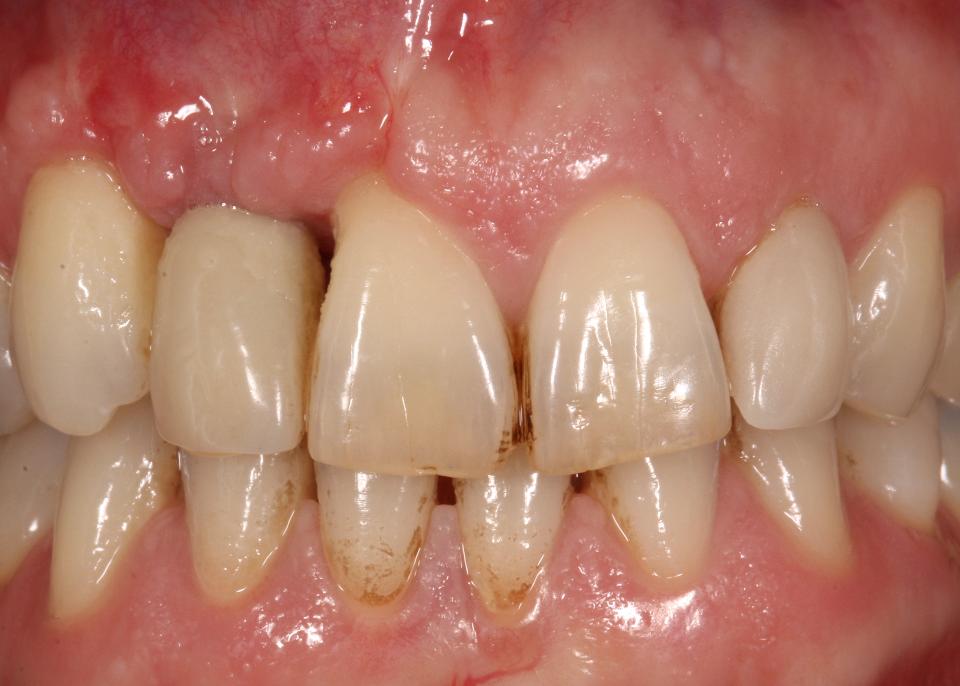 Şekil 14: Bir implant bölgesinde yumuşak doku augmentasyonunun tekrarlanan başarısızlıkları, komşu diş bölgesinde önemli yara izi ve çekilmeyle sonuçlanmıştır. Bu görüntü, cerrahi müdahale öncesinde vaka seçiminin ve teknik becerinin önemini vurgulamaktadır.