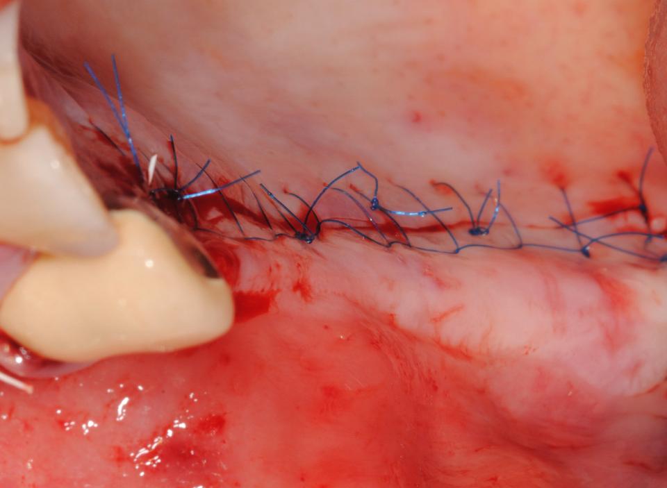 Fig. 7: Suture of the surgical site