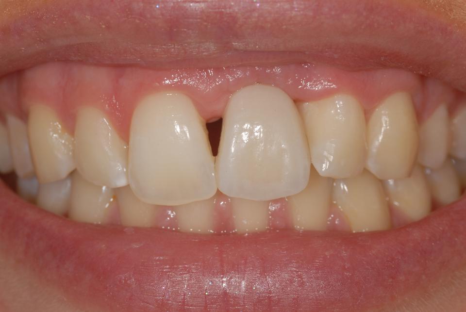 Fig. 3g: The direct comparison before (3g) and after (3h) completion of the combined adhesive and implant-based therapy underlines a marked improvement of a previously – from an esthetic point of view – severely compromised condition, despite the presence of a marked “gummy smile”. On the other hand, the clearly limited restorative possibilities when it comes to the correction of marked vertical soft tissue deficiencies have to be underlined