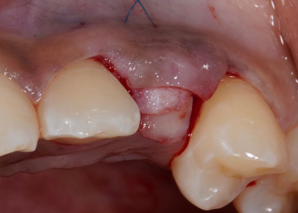 Fig. 20: The connective tissue graft is inserted and secured under the split thickness flap in the correct three-dimensional position to optimize its esthetic benefits at the point of reconstructing a pontic site