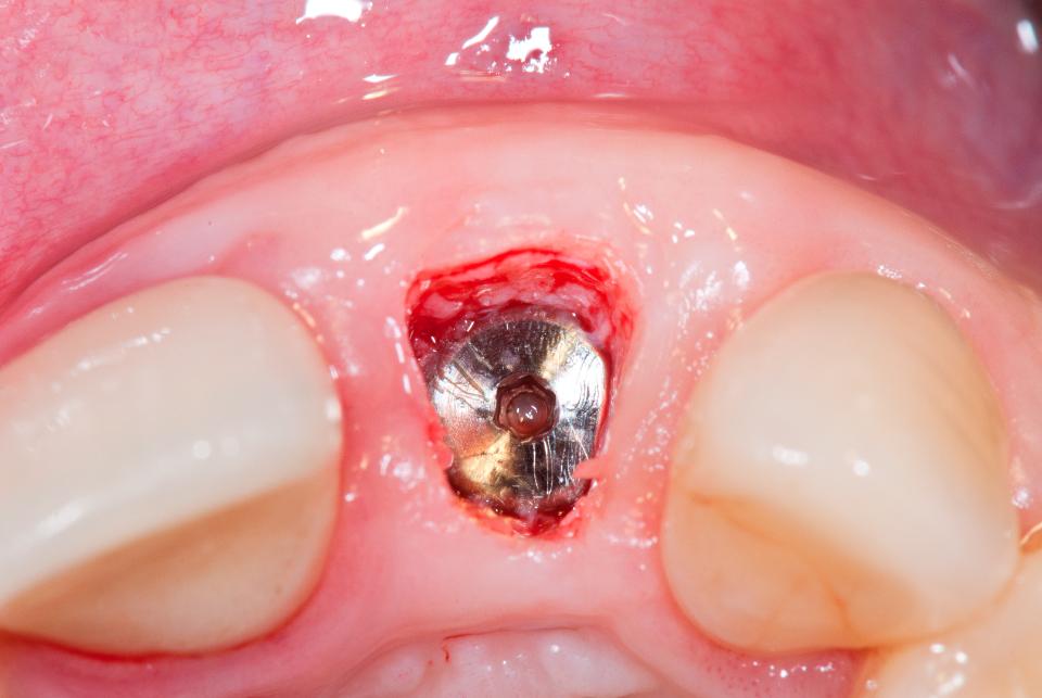 Fig. 15: If sufficient tissue is present, a simple individualized mucosal punch can be performed for uncoverage