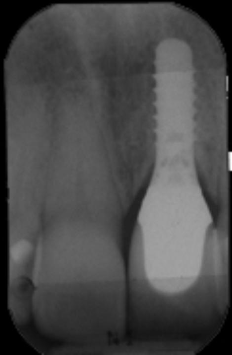 Fig. 7b: Implant 21 on the day of final crown insertion, 1.5 years post-implant-insertion. Peri-implant bone loss is visible