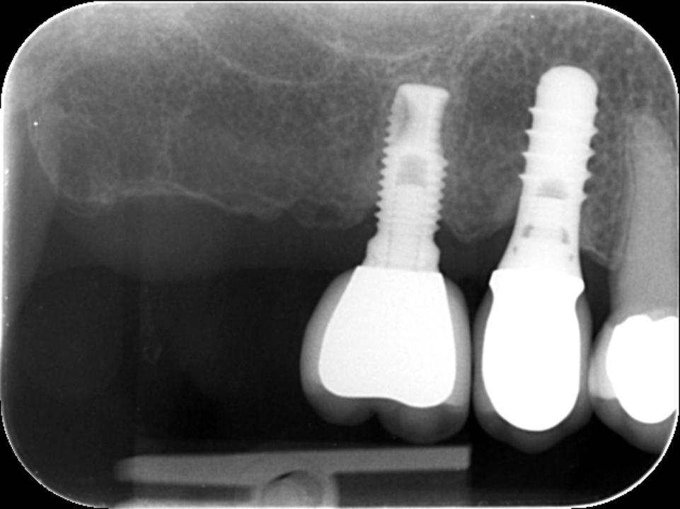 Şekil 1a: 25 yıl sonra 16 numara konumunda (üst sağ birinci molar) bruksizme bağlı implant kırığı (75-yaşında erkek hasta, mandibulada sabit implant restorasyonu) [Kaynak: N. U. Zitzmann]: Yerleştirmeden 20 yıl sonra radyografik görüntü. İmplantlar sağlam, hafif kemik rezorpsiyonu.