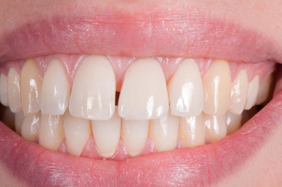 Fig. 5c: 10-year follow-up results with the smile line displaying an excellent esthetic outcome