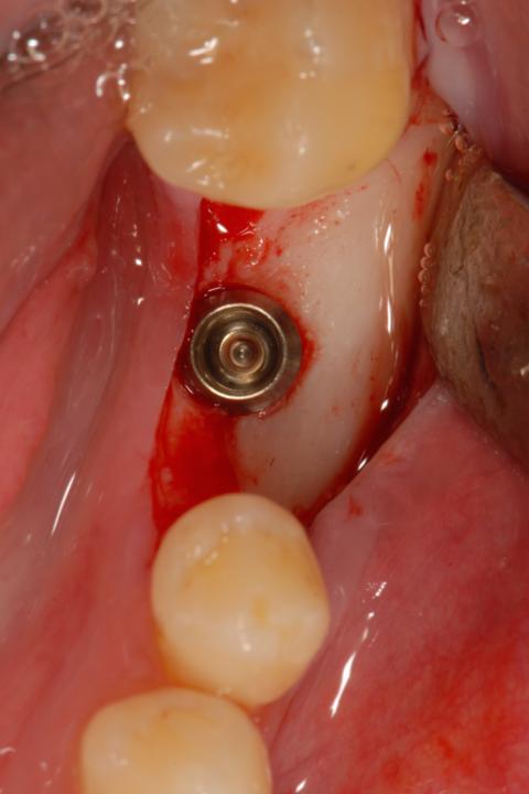 Fig. 3: Implant placement in region 36