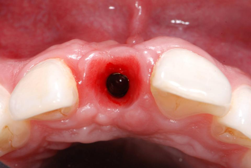 Fig. 6: Provisionalization and peri-implant soft tissue contouring