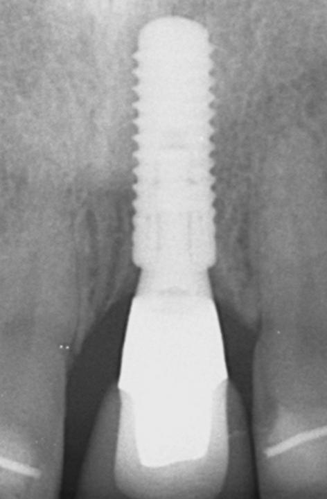 Fig. 5e: The peri-apical radiograph shows excellent stability of the crestal bone around the platform-switched bone level implant