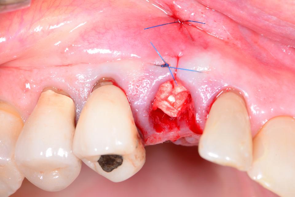 Fig. 3f: Following extraction, the socket was debrided and filled with a collagen plug to stabilize the blood clot. A small tear of the buccal gingiva was sutured with an interrupted suture